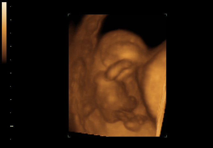 3D ultrasound image at 11 weeks